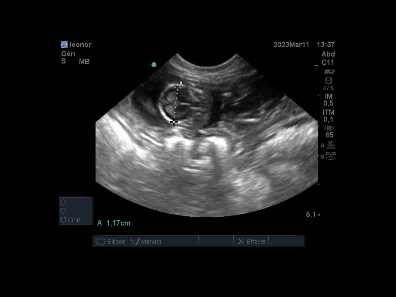 Ecografía / Ecografia